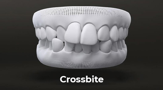 crossbite