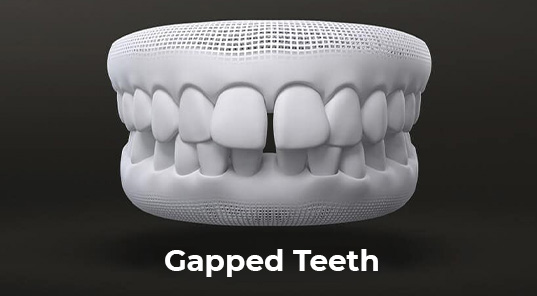gapped