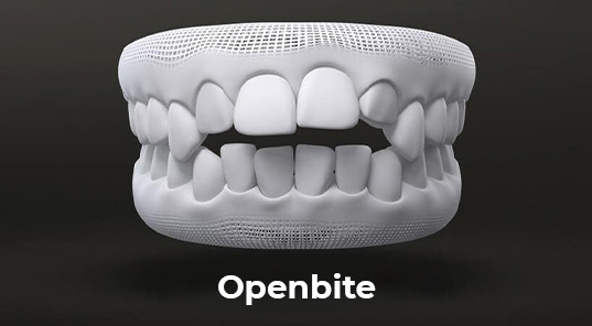 openbite