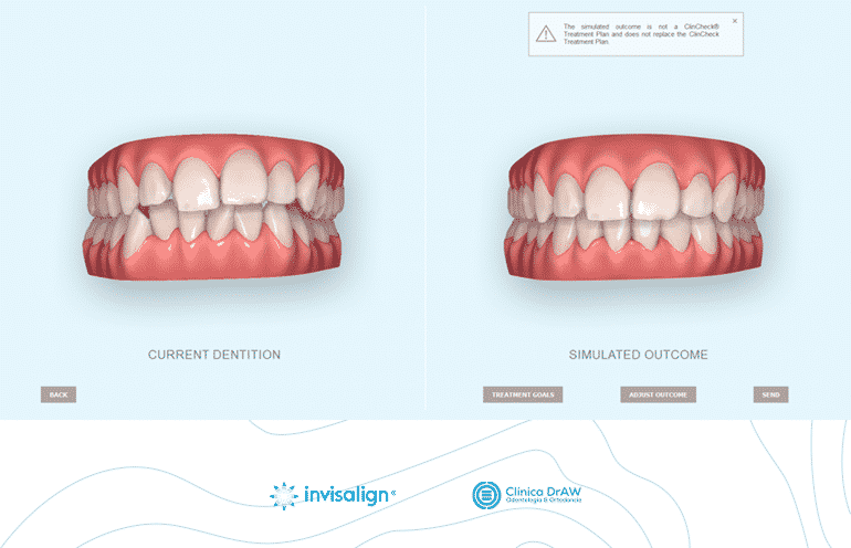 Invisalign Alineadores