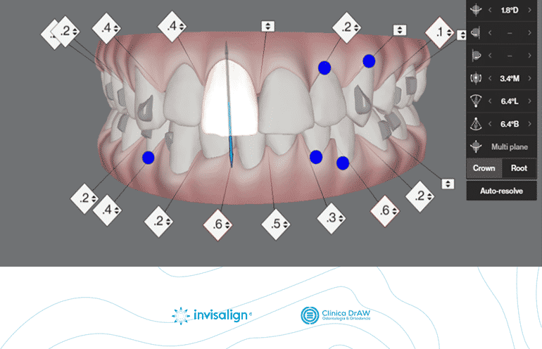 Ortodoncia Invisalign