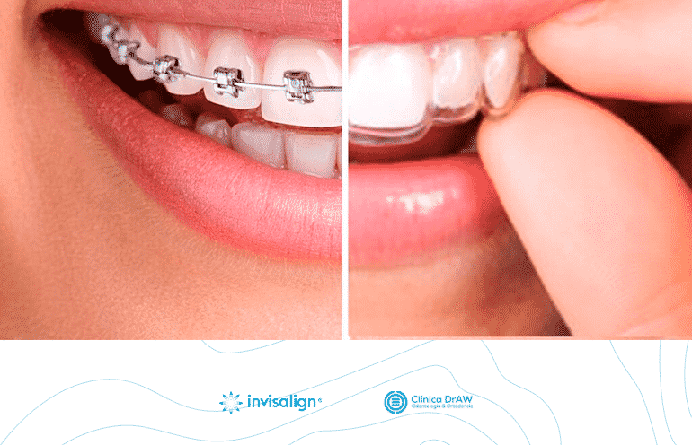 Ortodoncia Invisalign México