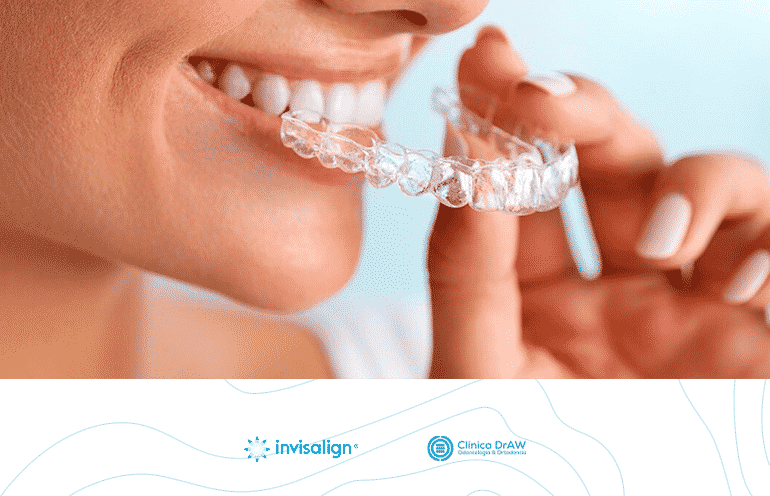 Invisalign Clear Aligners