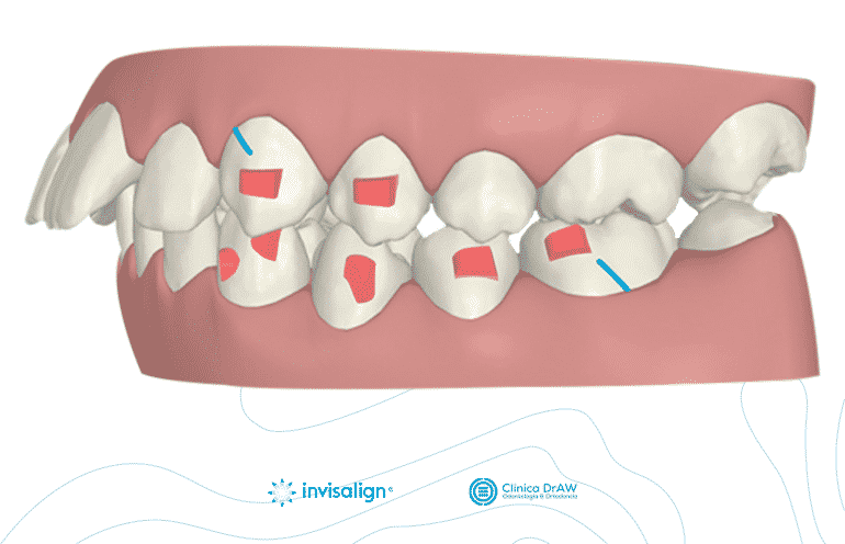 Invisalign Atache Diente