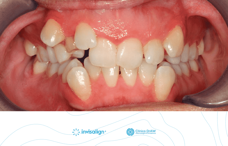 Invisalign México