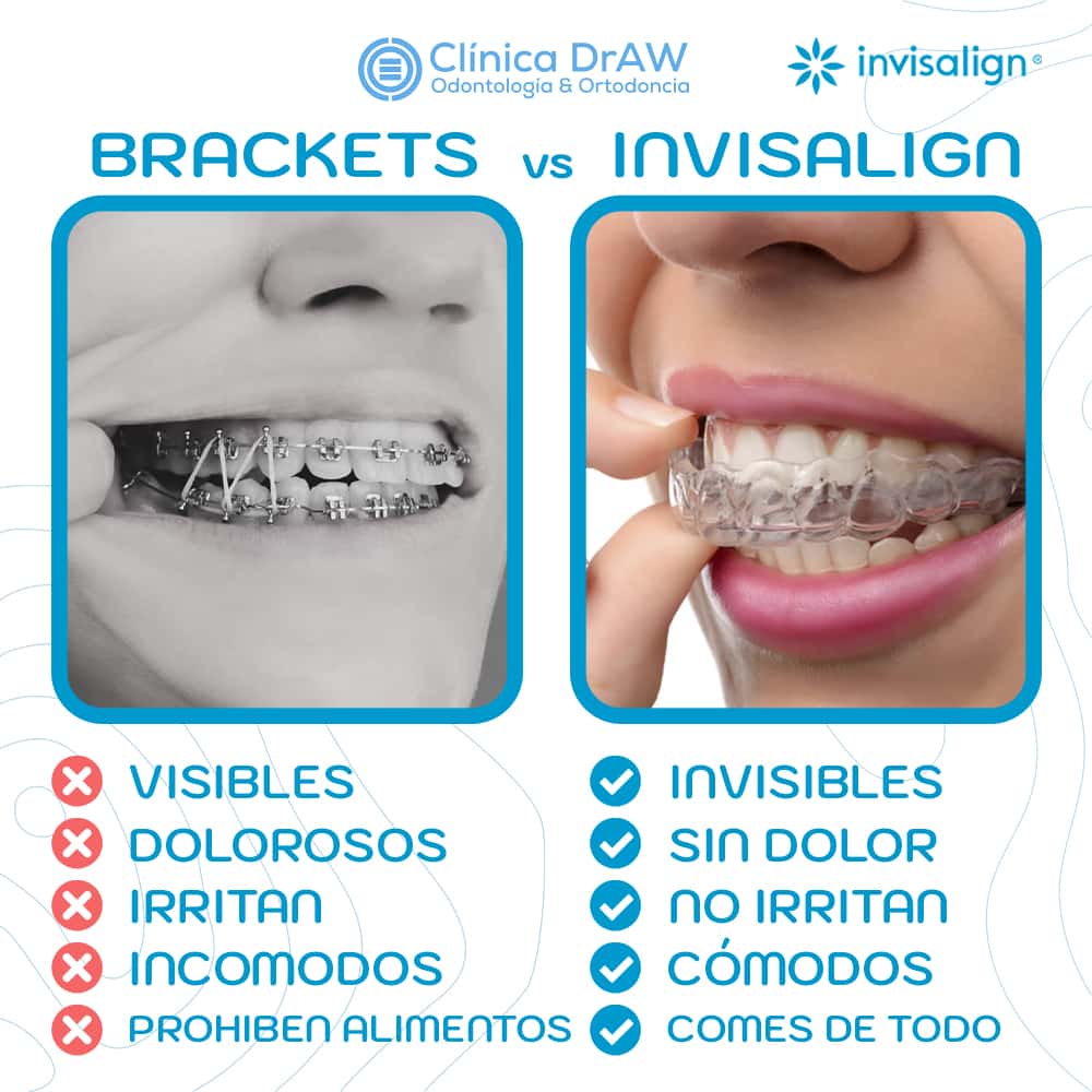 Brackets o Invisalign